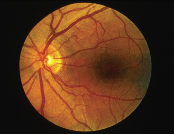 Normal Retina