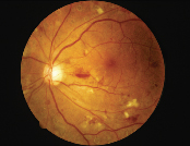 Retinal hemorrhages, cotton
wool spots and laser scars