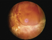 Retinal detachment