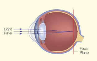 Short-sightedness