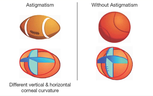 Astigmatism