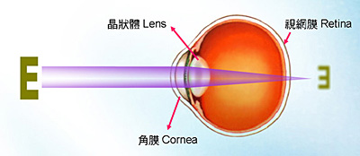  Presbyopia